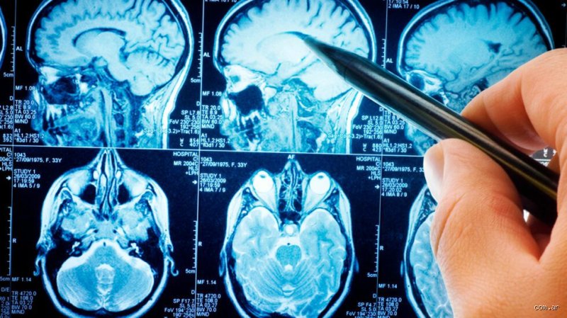 ¿Cómo se llama la enfermedad del cerebro cuando se inflama?