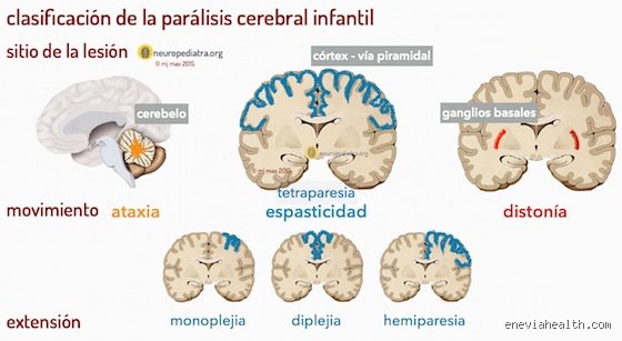 ¿La parálisis cerebral es una forma de autismo? Desmontando confusiones médicas comunes