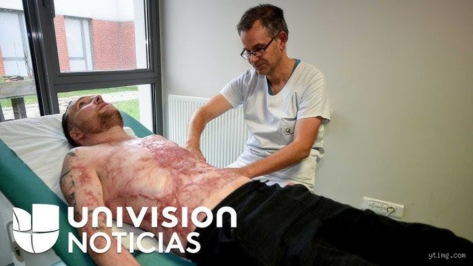 ¿Podrías sobrevivir a quemaduras del 40 por ciento? La cruda realidad científica y el límite de la resistencia humana