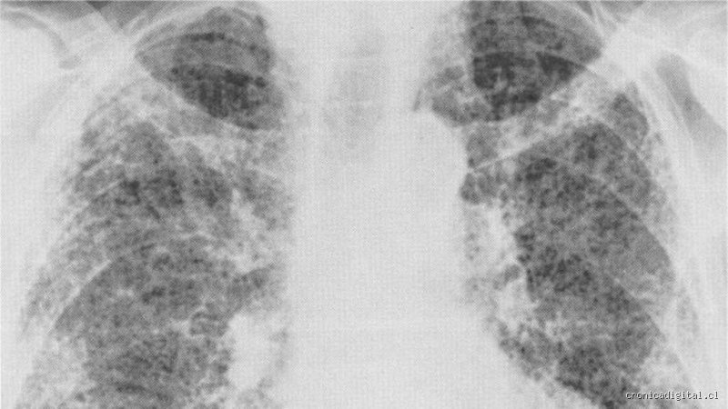 ¿Alguien ha logrado revertir alguna vez la fibrosis pulmonar? Realidad médica frente a los mitos del pulmón cicatrizado