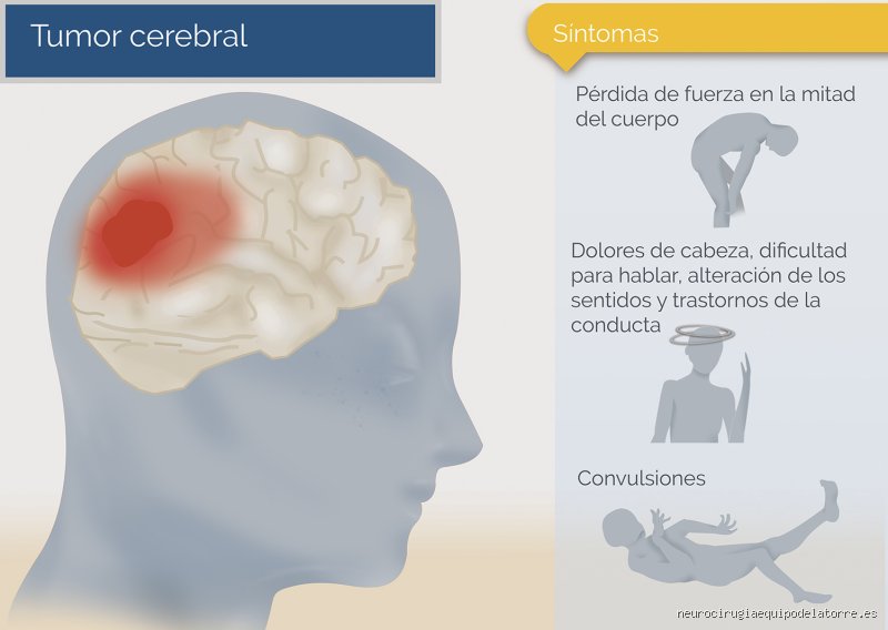 El enigma celular: ¿Cómo comienza el cáncer en el cerebro y por qué desafía todo lo que sabemos sobre la biología?