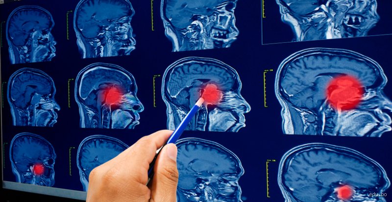 ¿Cómo evitar el cáncer de cerebro? Claves médicas y realidades sobre la prevención de tumores cerebrales hoy