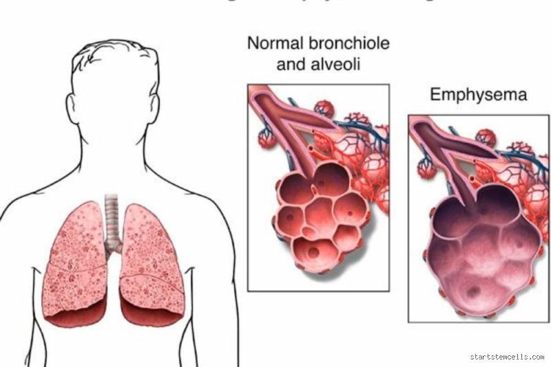 ¿Cómo frenar el enfisema pulmonar y recuperar el aliento en un mundo que asfixia tus pulmones?