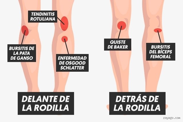 ¿Cómo quitar el dolor de rodilla rápido y efectivo? La guía definitiva de alivio real