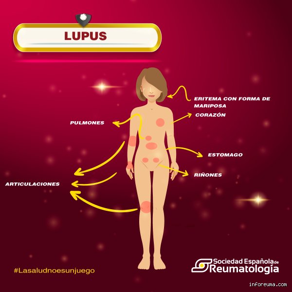 ¿Cómo saber si estoy desarrollando lupus? Guía médica para entender las señales de una enfermedad que engaña a todos