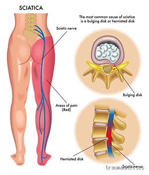 ¿Cómo saber si tengo problemas en los nervios de las piernas? Guía experta para detectar señales de alerta temprana