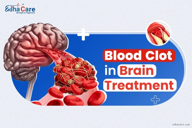 Cómo se deshacen los coágulos de sangre en el cerebro: la carrera contrarreloj contra la isquemia cerebral