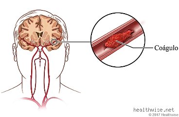 Cómo se elimina un coágulo de sangre en el cerebro: las técnicas de rescate neuronal que desafían al reloj biológico
