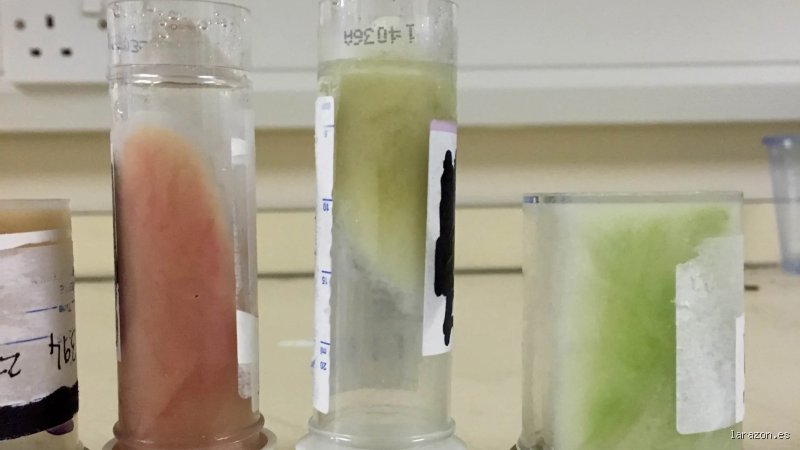 ¿Cómo se ven las flemas de neumonía? Guía visual y médica para identificar la infección pulmonar a tiempo