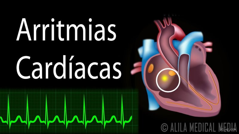 ¿Cómo suena una arritmia cardíaca? Guía completa para identificar los latidos que rompen el compás de tu vida
