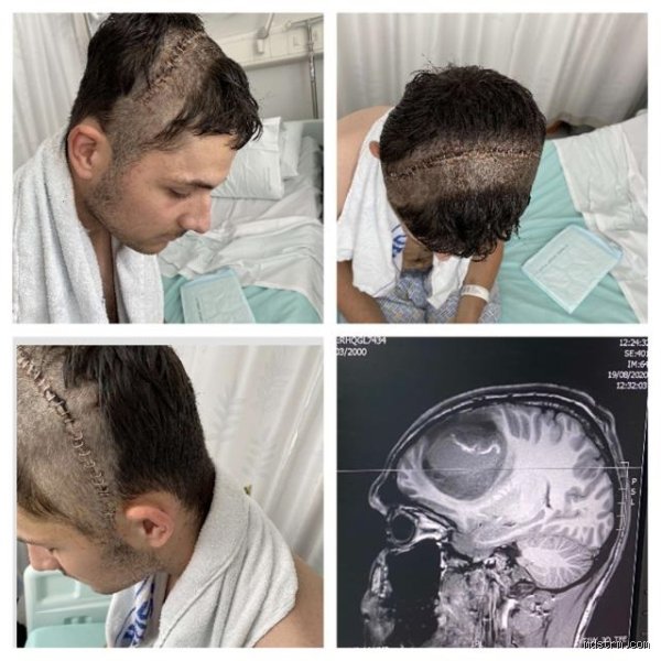 ¿Cuál es el peor cáncer de cabeza? Radiografía de los diagnósticos más agresivos en oncología maxilofacial y cerebral