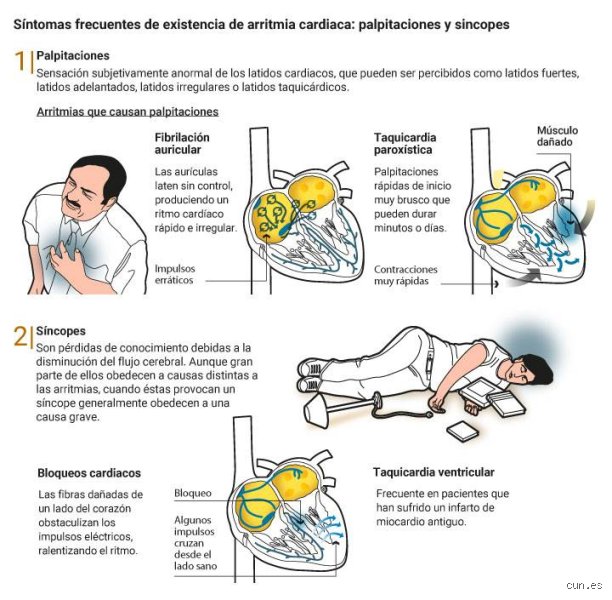 ¿Cuál es la arritmia más peligrosa? Un análisis profundo sobre las tormentas eléctricas del corazón humano