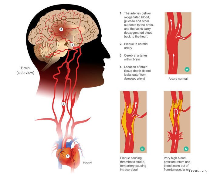 ¿Cuál es la enfermedad cerebral más mortal? Un viaje al epicentro del abismo neurológico y sus sombras