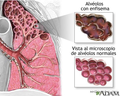 ¿Cuál es la enfermedad pulmonar más grave? La realidad médica frente a la percepción del paciente