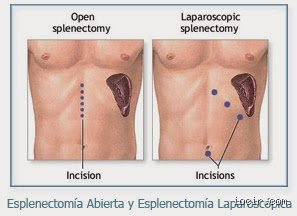 Más allá del mito: Descubre cuál es la infección más común que afecta al bazo y por qué ignorarlo es un error fatal