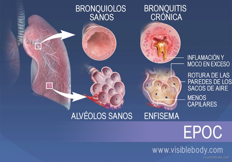 Respirar no debería ser un acto de fe: un análisis profundo sobre cuáles son dos enfermedades que afectan a los pulmones