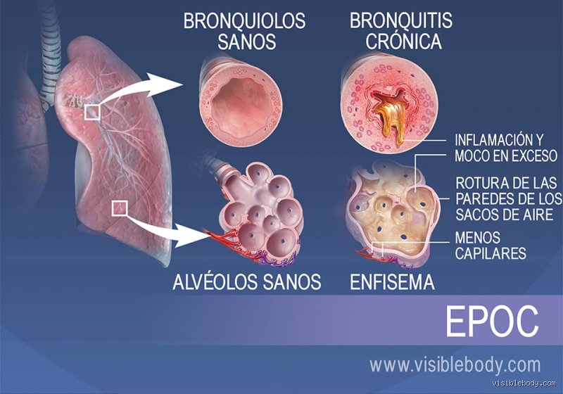¿Cuáles son las 4 enfermedades respiratorias que definen la salud pública actual y cómo entender su impacto real?