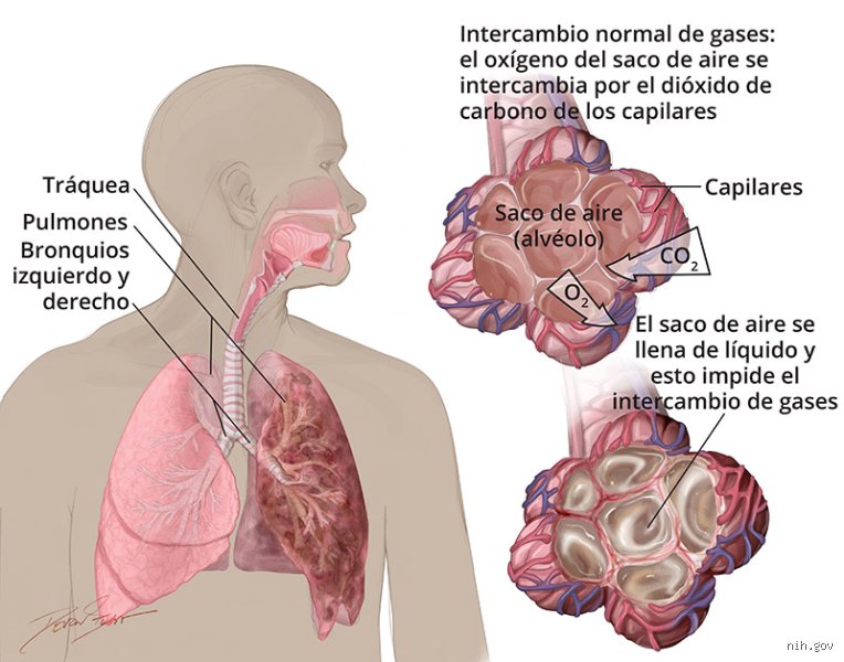 Entender el ahogo: ¿Cuáles son las causas comunes de dificultad para respirar y cuándo debemos preocuparnos de verdad?