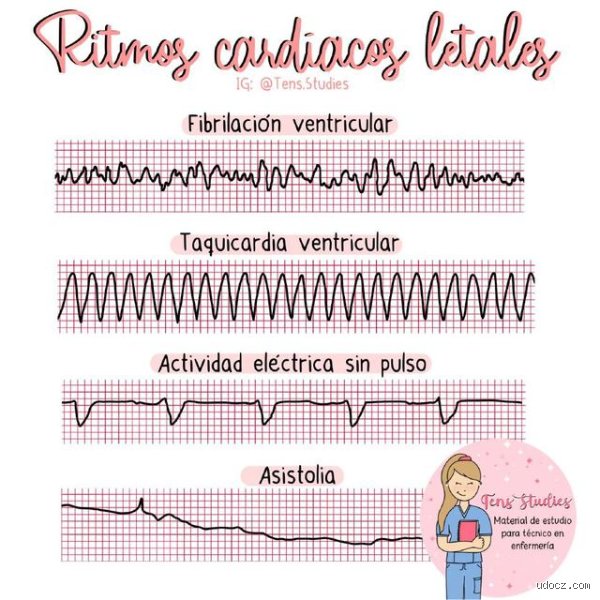 Los 4 ritmos cardíacos letales: una guía médica para identificar el colapso eléctrico que detiene la vida