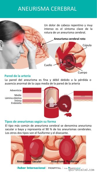 ¿Cuáles son los síntomas de un aneurisma cerebral? Una guía crítica sobre las señales silenciosas y el estallido repentino