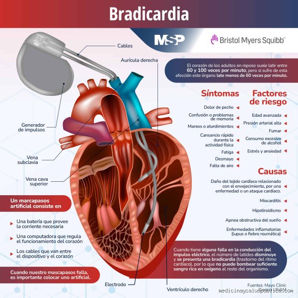 ¿Cuándo se considera peligrosa la bradicardia? Guía médica para entender cuándo tu corazón late demasiado lento