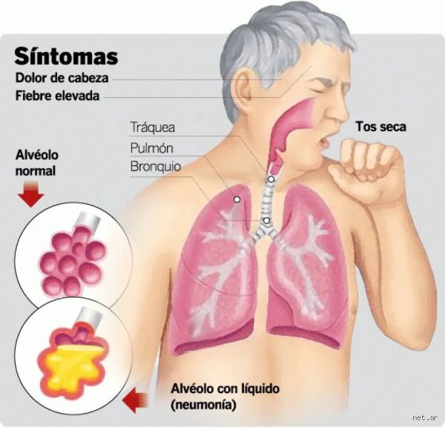 ¿Cuando tienes neumonía toses mucho? Desmontando el mito del síntoma único en las infecciones pulmonares agudas
