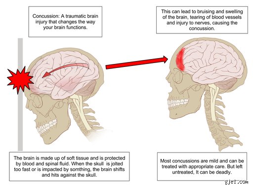 ¿Cuánto dura una lesión cerebral? La cruda realidad tras el cronómetro de la recuperación neurológica y sus mitos