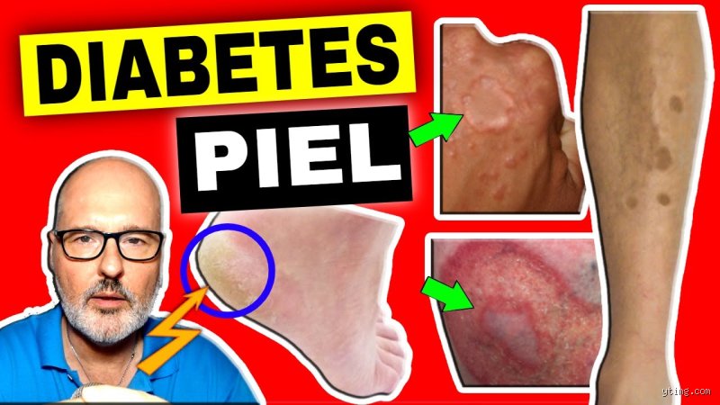 ¿Dónde da picazón la diabetes y por qué ignorar ese rascado constante es el error más peligroso para tus nervios?