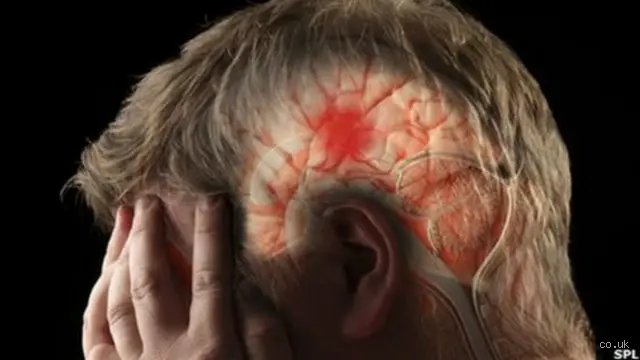 ¿Dónde duele antes de un derrame cerebral? Las señales de alarma silenciosas que tu cuerpo envía antes del colapso