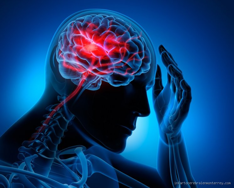 ¿Dónde duele antes de un derrame cerebral? Las señales de alarma que tu cuerpo envía antes de la tormenta neurológica