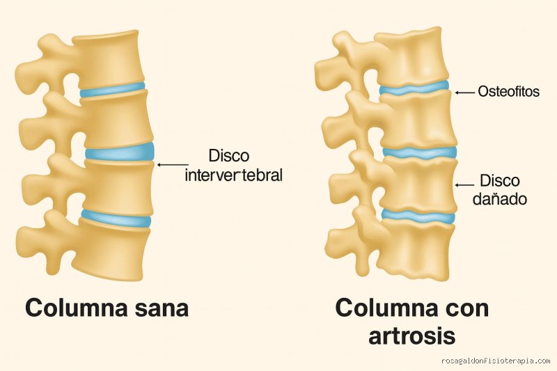 Más allá del cuello rígido: el mapa real del dolor cuando hay artrosis cervical y por qué ignorarlo es un error