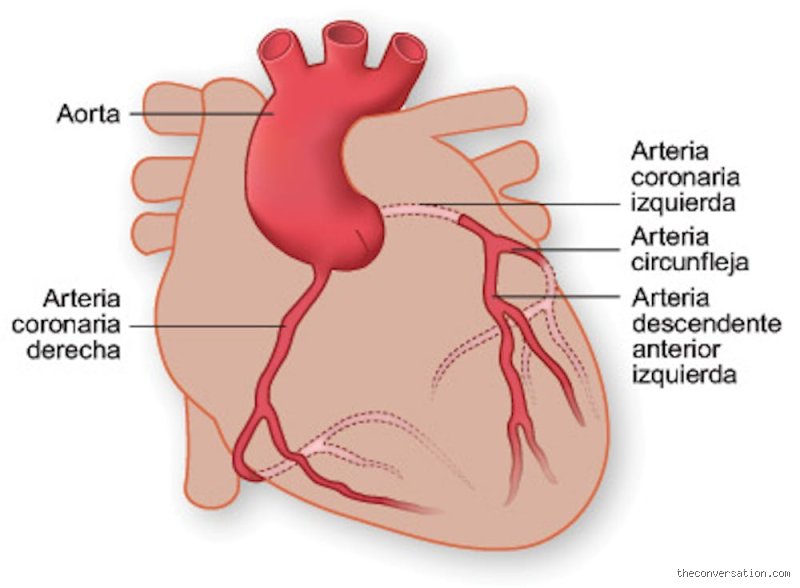 ¿Dónde duele el corazón en un infarto? Descifrando el mapa del dolor torácico y sus señales engañosas