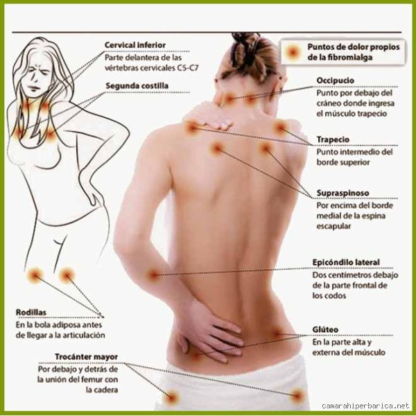 ¿Dónde duele la fibromialgia? Guía completa para entender el mapa del dolor crónico invisible