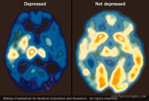 ¿El cerebro cambia con la depresión y qué significa esto para tu salud mental profunda?