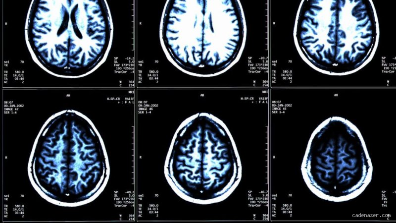 ¿El insomnio familiar fatal es una enfermedad priónica? Descifrando el enigma de la proteína que asesina el sueño