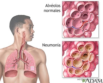 ¿Por qué la neumonía empeora por la noche? La verdad científica sobre las crisis respiratorias nocturnas