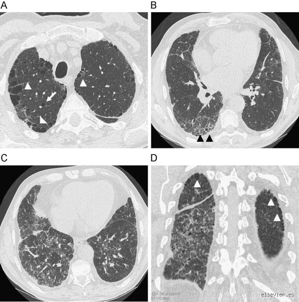 ¿Es la fibrosis pulmonar peor que la EPOC? Analizamos la realidad de estas patologías respiratorias crónicas
