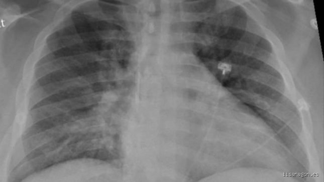 ¿Es realmente posible recuperar unos pulmones dañados tras años de castigo o enfermedades crónicas severas?