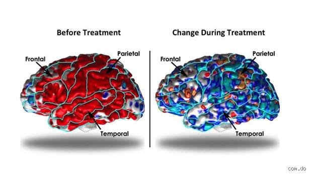 ¿Puede el cerebro recuperarse completamente de la depresión? La verdad científica sobre la neuroplasticidad y el retorno al equilibrio