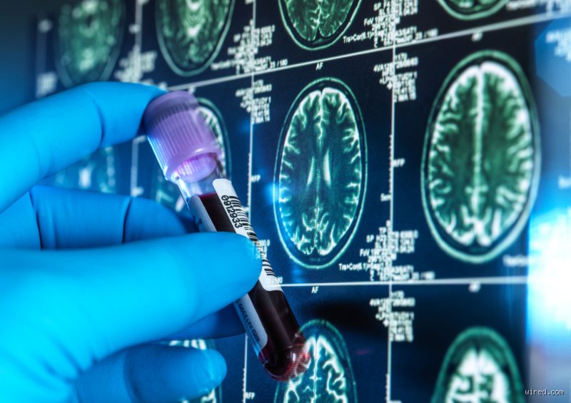 ¿Puede un análisis de sangre detectar la demencia de forma temprana y qué tan cerca estamos de la realidad clínica?
