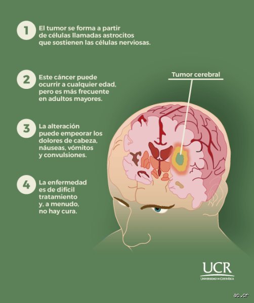 ¿Se puede prevenir el glioblastoma? Realidades incómodas sobre el tumor cerebral más agresivo y los límites de la medicina actual