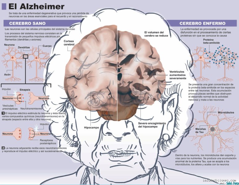 ¿Se vive más tiempo con Alzheimer o demencia? Claves científicas y realidades sobre la esperanza de vida real