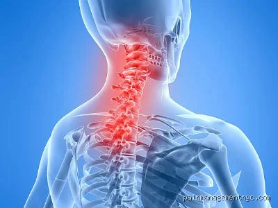 ¿Tiene cura la artritis de cuello? La cruda realidad tras el desgaste cervical y las falsas promesas