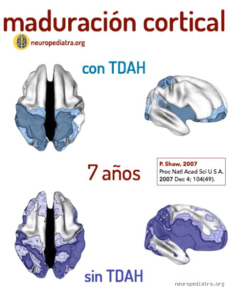 ¿Cuándo maduran los niños con TDAH? La ciencia detrás del retraso en el desarrollo cerebral y sus implicaciones reales