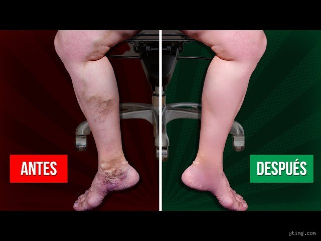 ¿Ayuda elevar las piernas con los coágulos de sangre? La verdad médica detrás de un remedio tradicional y sus riesgos