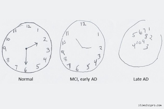¿Cuál es el test del reloj y por qué muchos lo interpretan mal?